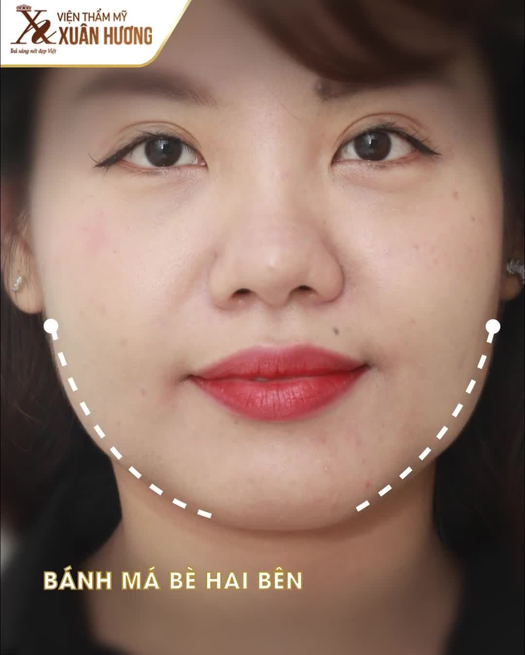 SIÊU ƯU ĐÃI : VGOLD HIFU CHỈ 3,999k  Công nghệ 3 KHÔNG: Không xâm lấn - không sưng đau - không nghỉ dưỡng