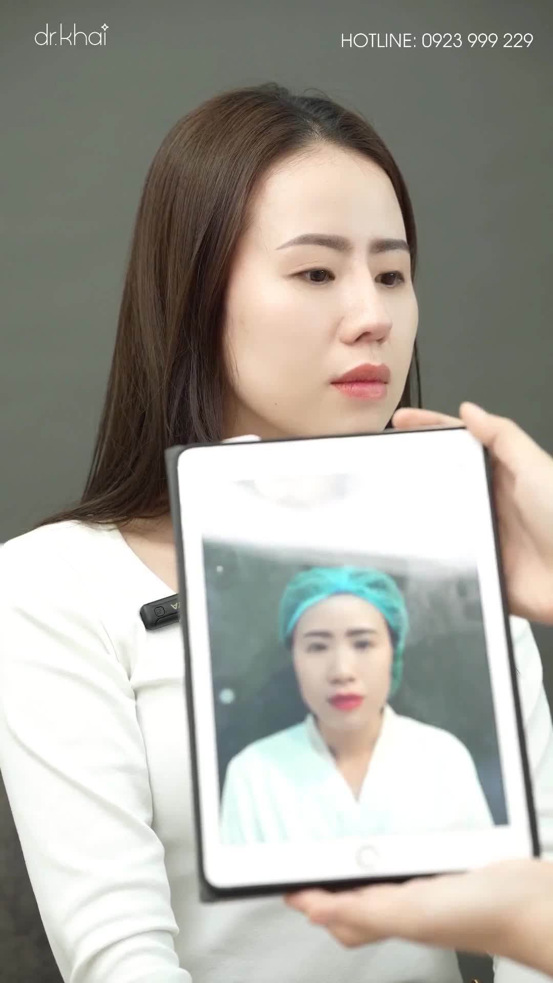 NÂNG MŨI KHÔNG ĐAU - DÁNG MŨI ĐẸP SAU 1 THÁNG