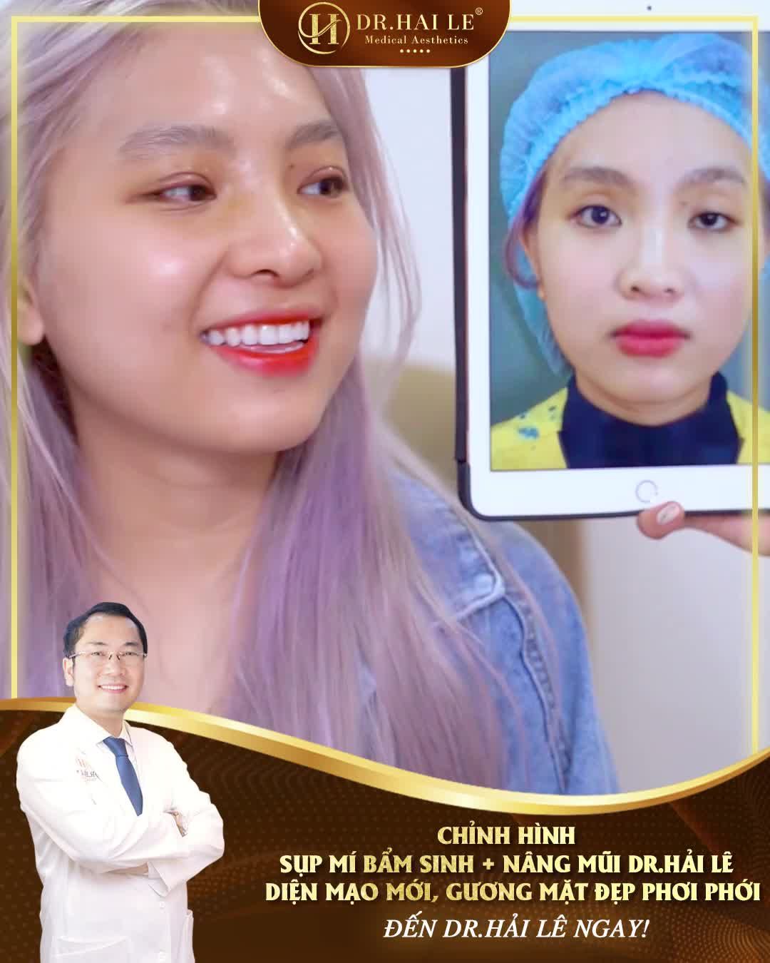 Đã từng chỉnh hình sụp mí bẩm sinh nhưng kết quả đôi mắt sụp lại như lúc đầu, vị khách hàng quyết định đặt trọn niềm tin vào Dr.Hải Lê!