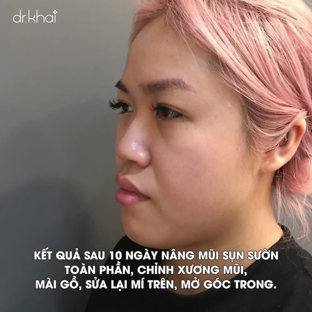 Khách quay lại tái khám sau hơn 10 ngày thực hiện combo thẩm mỹ nâng mũi sụn sườn toàn phần, chỉnh xương mài gồ, mí trên sửa lại, mở góc mắt trong.