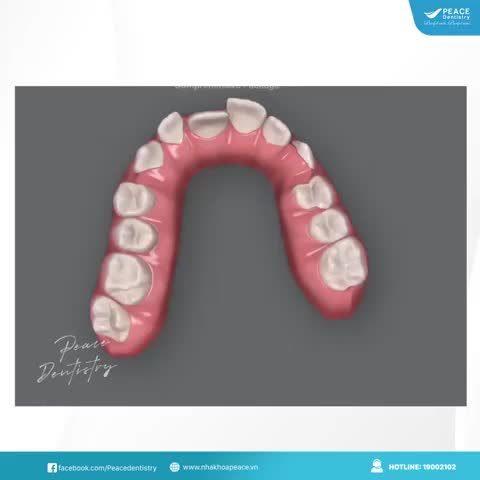 ​​​​​​​Clincheck trong chỉnh nha invisalign