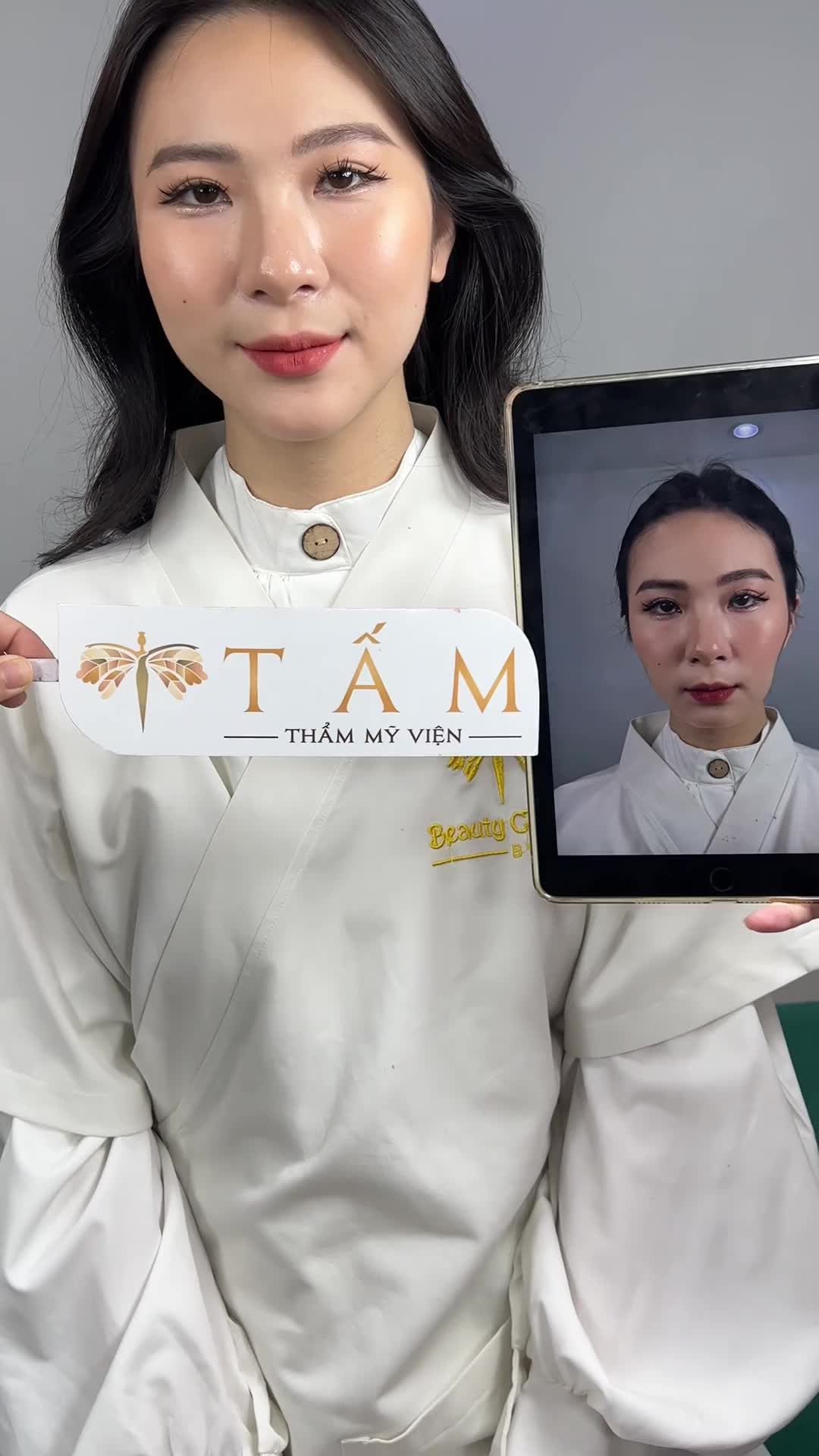 Gương mặt tươi trẻ chỉ sau 30 phút nhờ combo Filler má, cằm.
