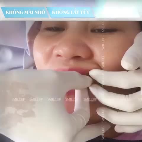 LÀM RĂNG SỨ NHƯNG MÀI CỰC ÍT - HOẶC KHÔNG CẦN MÀI