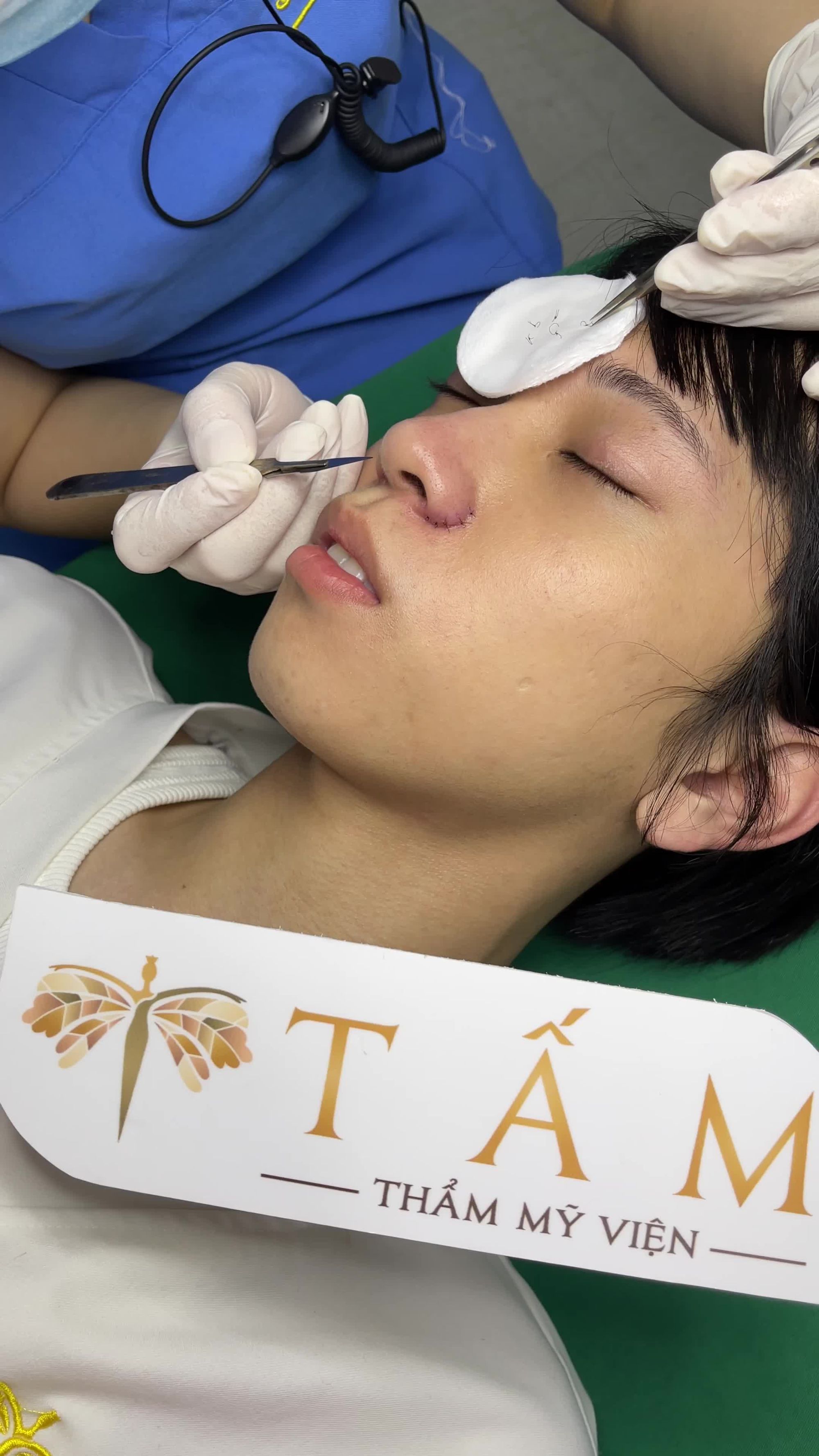 Ca filler má tại phòng khám TMV Tấm.