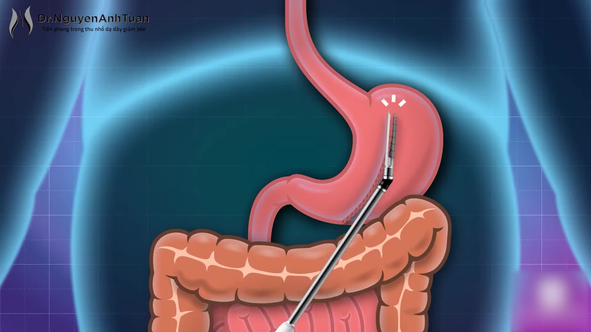 Sự thay đổi rõ rệt của những bệnh nhân đã lựa chọn phương pháp phẫu thuật nội soi thu nhỏ dạ dày để giảm béo.