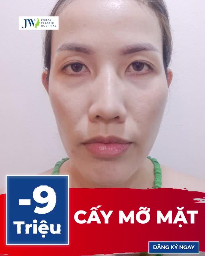 U40 MẶT HỐC HÁC HOÁ CĂNG MƯỚT NHƯ EM BÉ SAU 1 LẦN CẤY MỠ MẶT