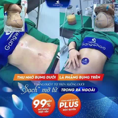 THU NHỎ BỤNG DƯỚI - LÀ PHẲNG BỤNG TRÊN VỚI LIPO ULTRASOUND