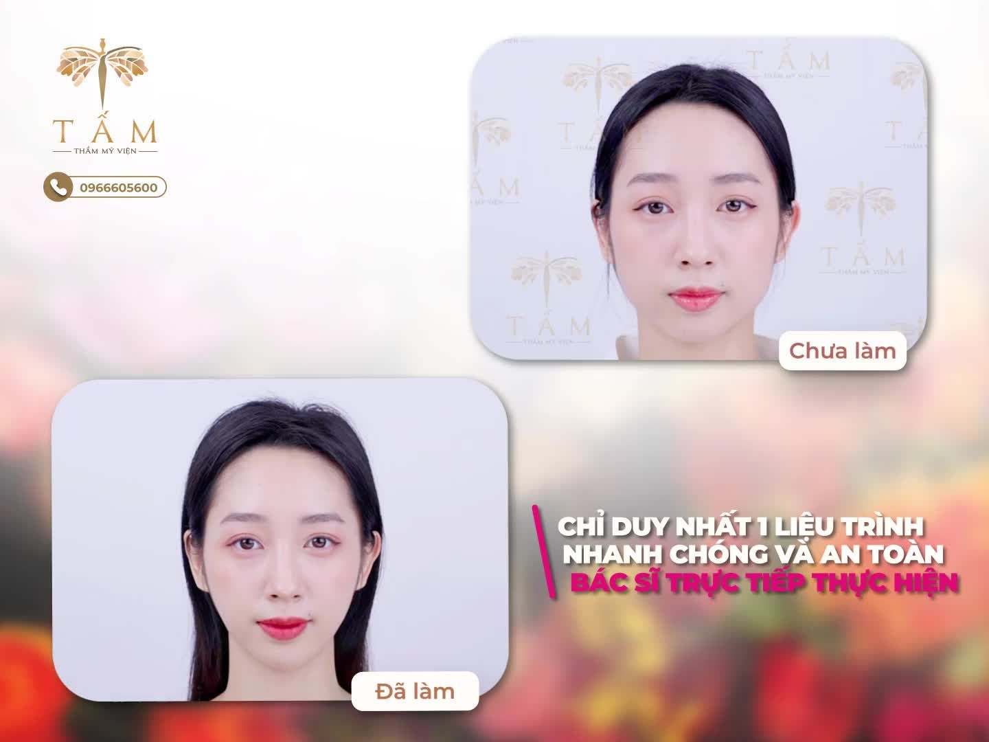 Nắng đã có mũ, mưa đã có ô, thon gọn hàm đã có Vline Perfect