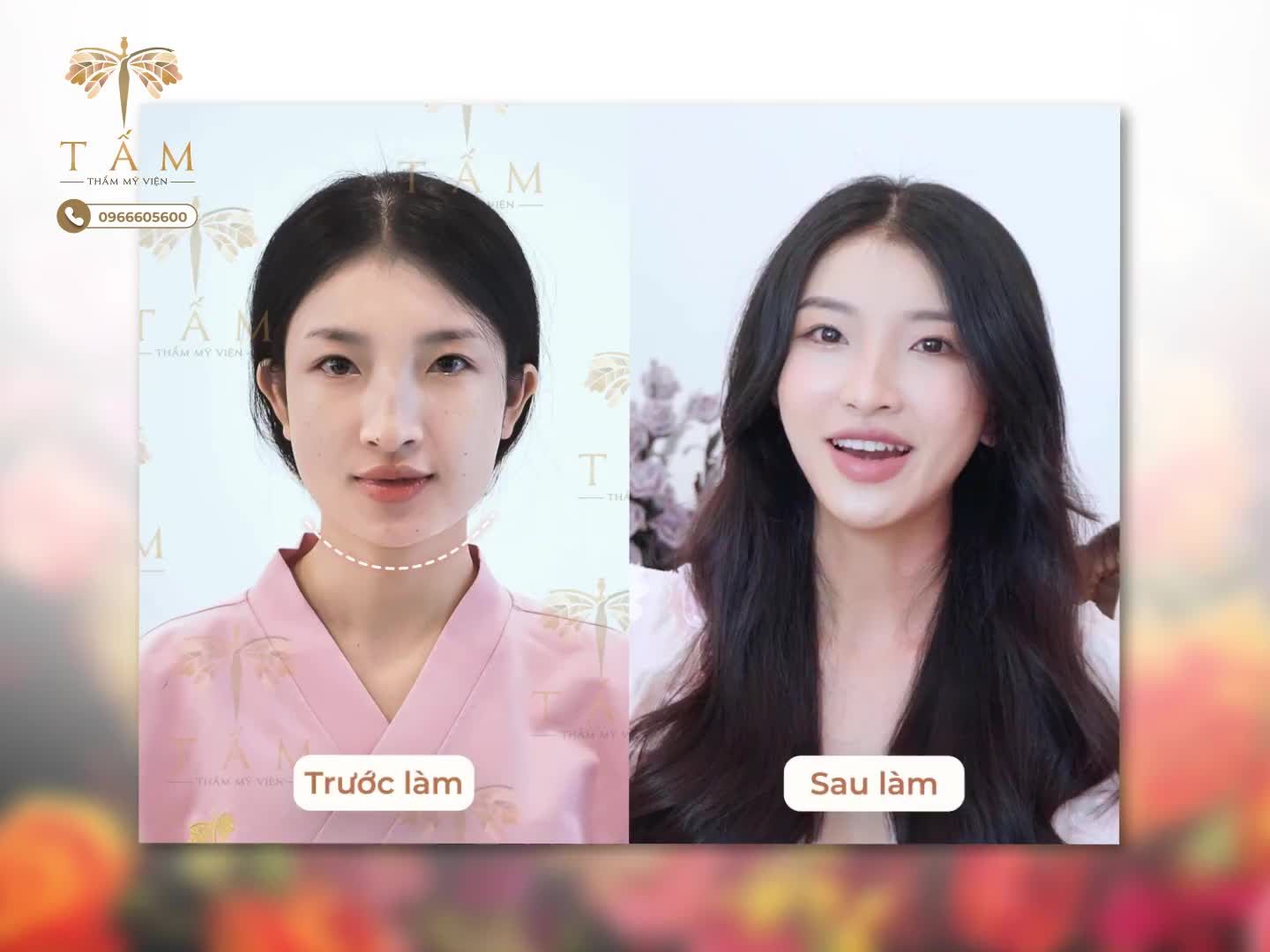 VLINE PERFECT - “BÍ QUYẾT” THON GỌN HÀM