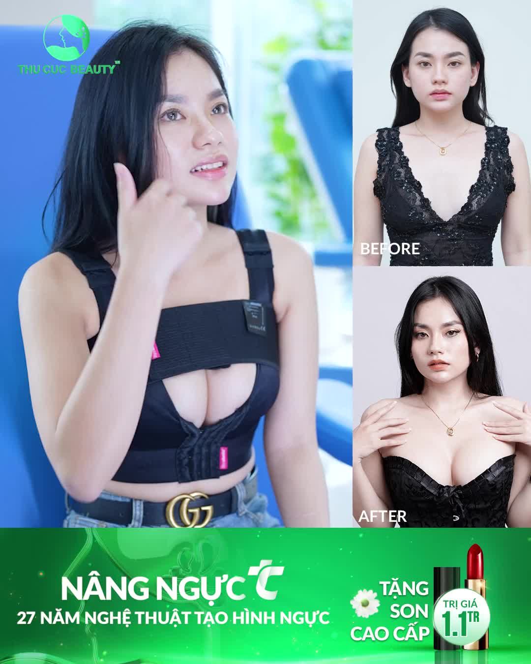 Nâng ngực KHÔNG ĐAU - KHÔNG CHẢY MÁU Inbox ngay!!!