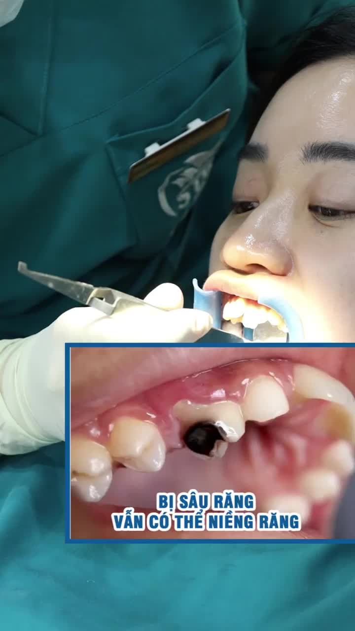 Bị sâu răng có niềng răng được không?
