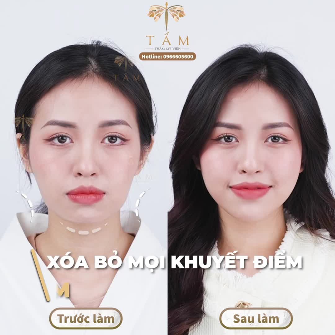 Tự ti với diện mạo tiều tuỵ, ngại gặp gỡ bạn bè, đánh mất nhiều cơ hội tốt của bạn thân cũng chỉ vì gương mặt kém sắc là chia sẻ của bạn Mai Hạnh - khách hàng Filler tại Tấm.