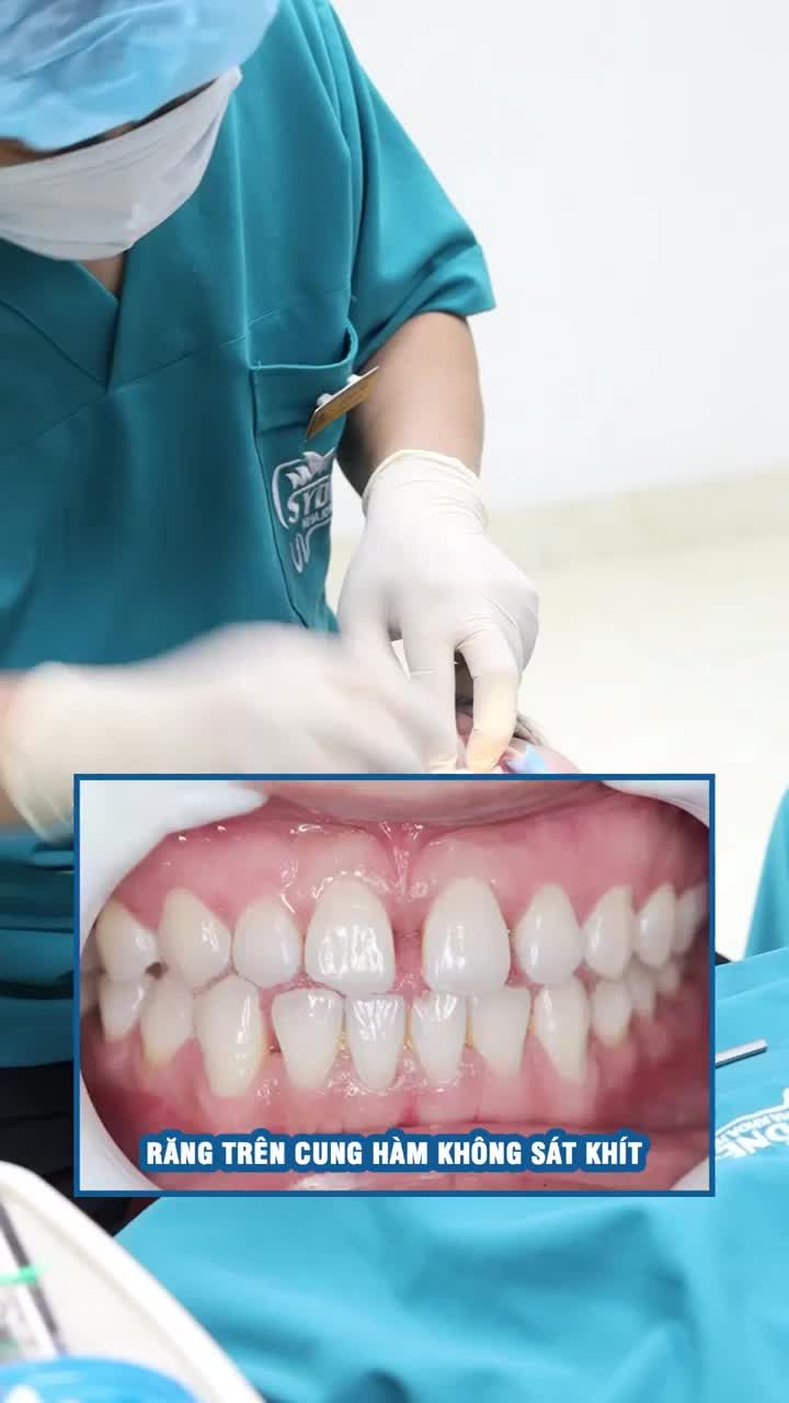 Răng thưa nên niềng hay bọc sứ ?