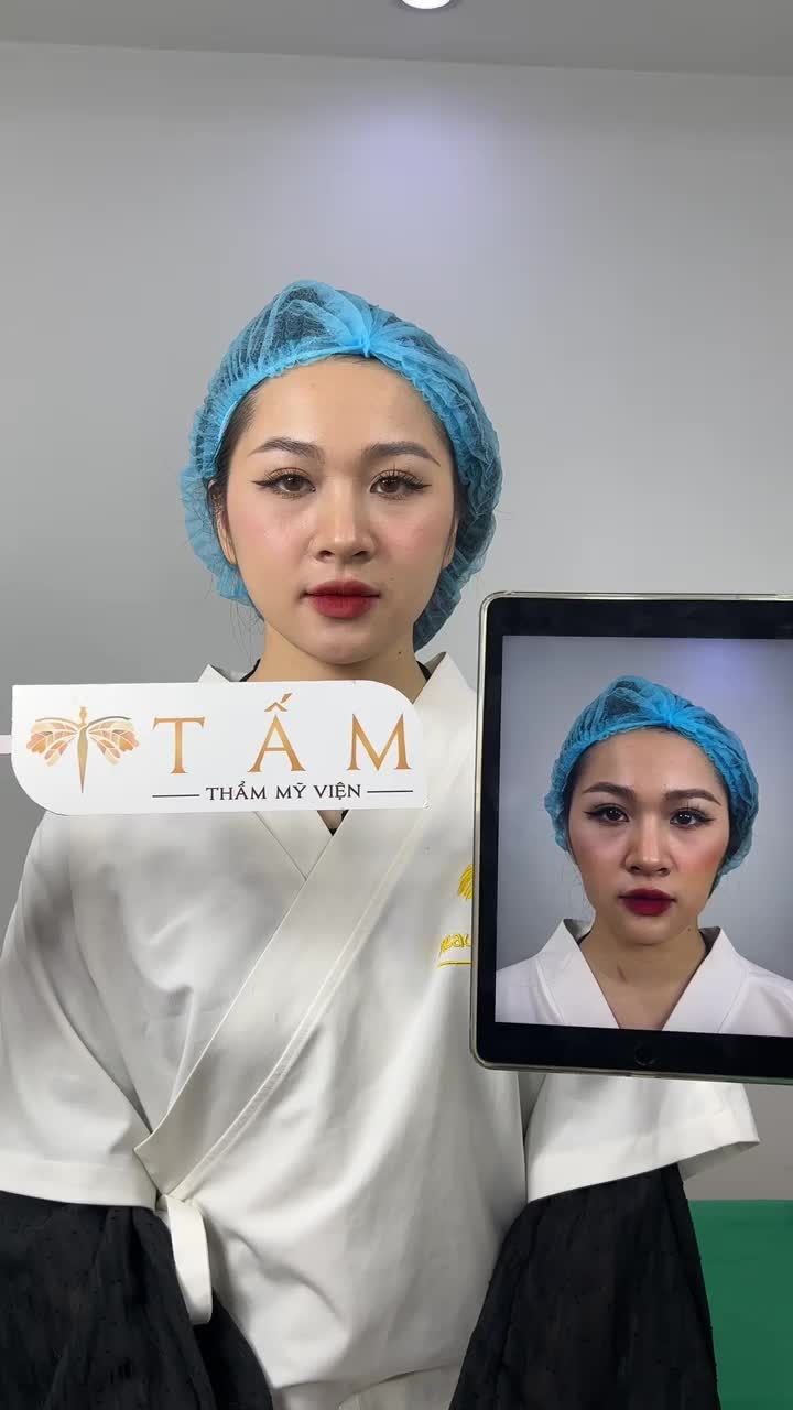 Thay đổi diện mạo chỉ sau 30 phút với Filler tại Tấm.