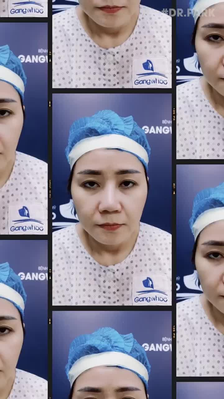 NHỮNG LƯU Ý TRƯỚC KHI SỬA LẠI MŨI HỎNG