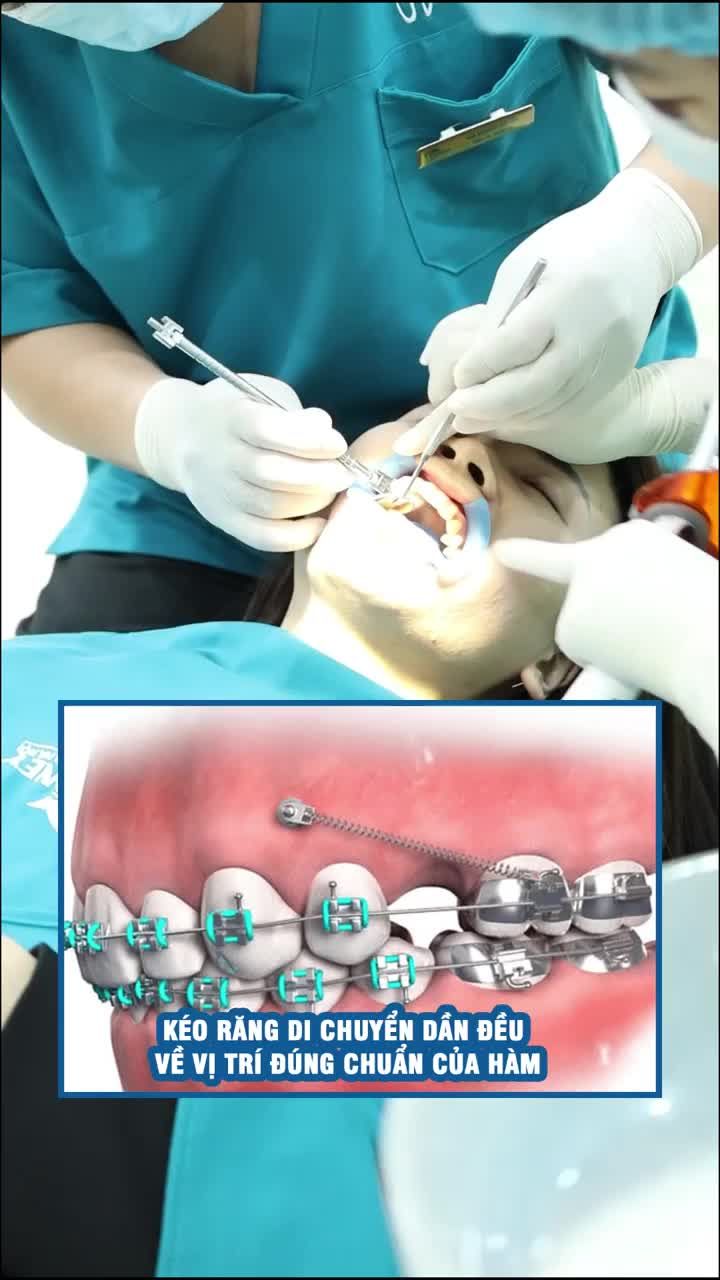 Niềng răng có ảnh hưởng đến thần kinh không?
