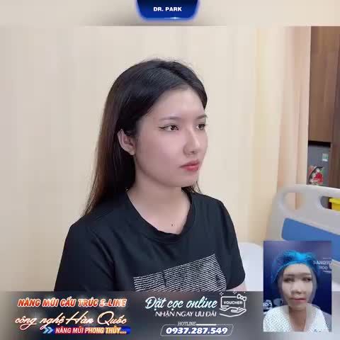 NÂNG MŨI CẤU TRÚC CÓ VĨNH VIỄN KHÔNG?