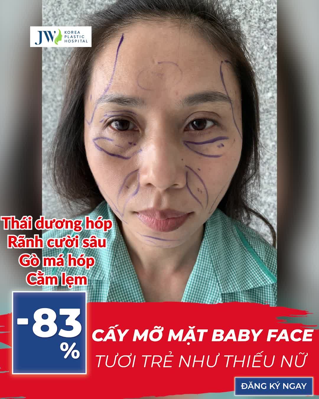 CẤY MỠ MẶT BABY FACE - BÍ QUYẾT TRẺ HƠN 10 TUỔI