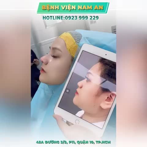 NGAY SAU KHI NÂNG MŨI TẠI BV NAM AN - KHÔNG HỀ SƯNG ĐAU!