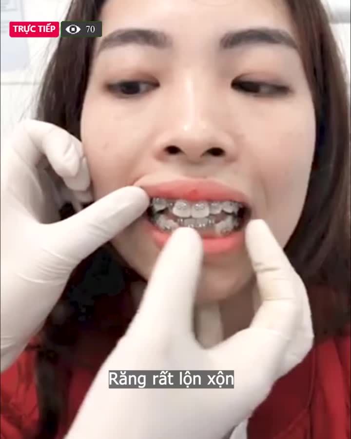 Răng Khấp Khểnh, Lộn Xộn Mấy Cũng Đều