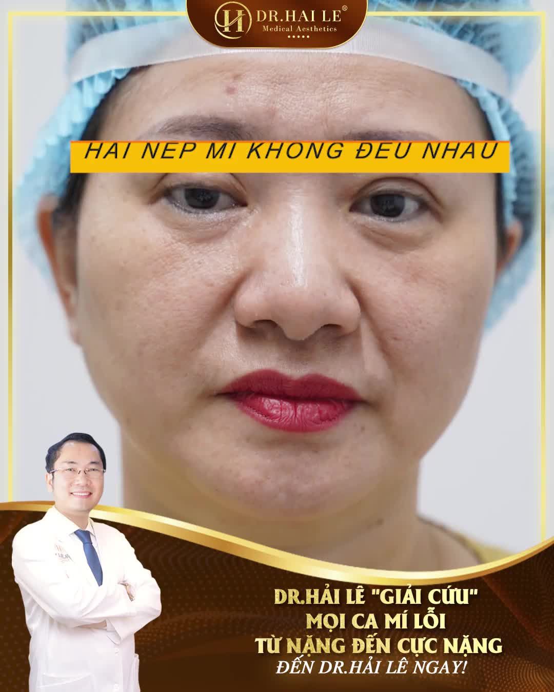"Chị đã thức tới 2h sáng chỉ để xem những video, hình ảnh sửa mí bên Dr.Hải Lê