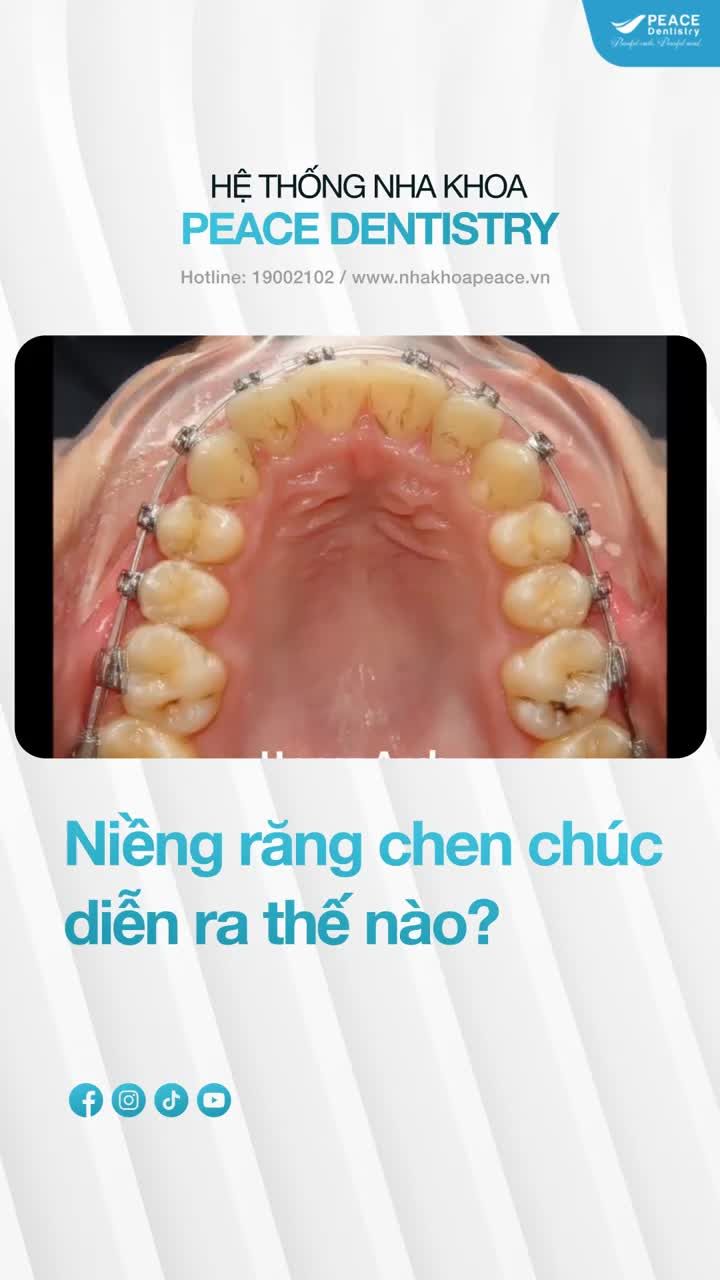 Cải thiện tình trạng răng - hàm sai lệch, mang lại tính thẩm mỹ cao