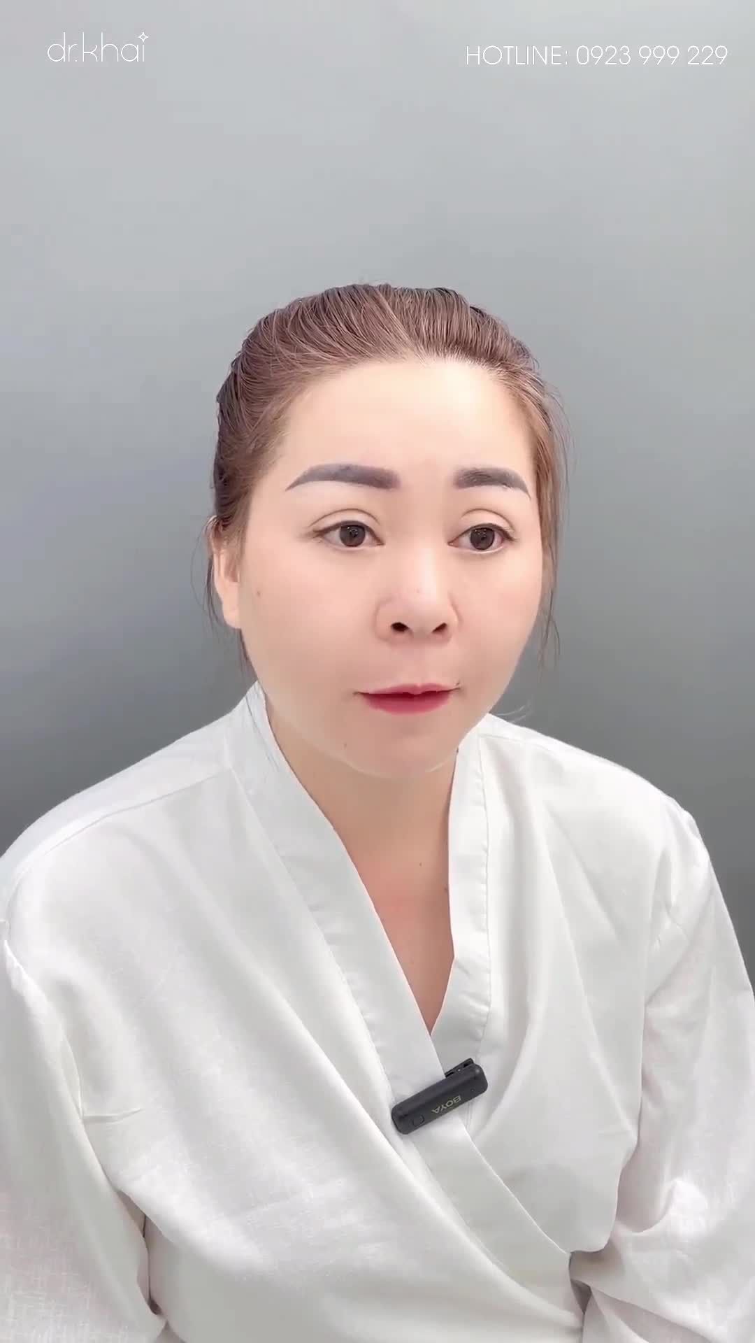 Mũi khách hàng từng can thiệp qua phương pháp nâng mũi nhưng sau 1 thời gian mũi gặp viêm nhiễm phải lấy sụn ra khỏi khoang mũi.