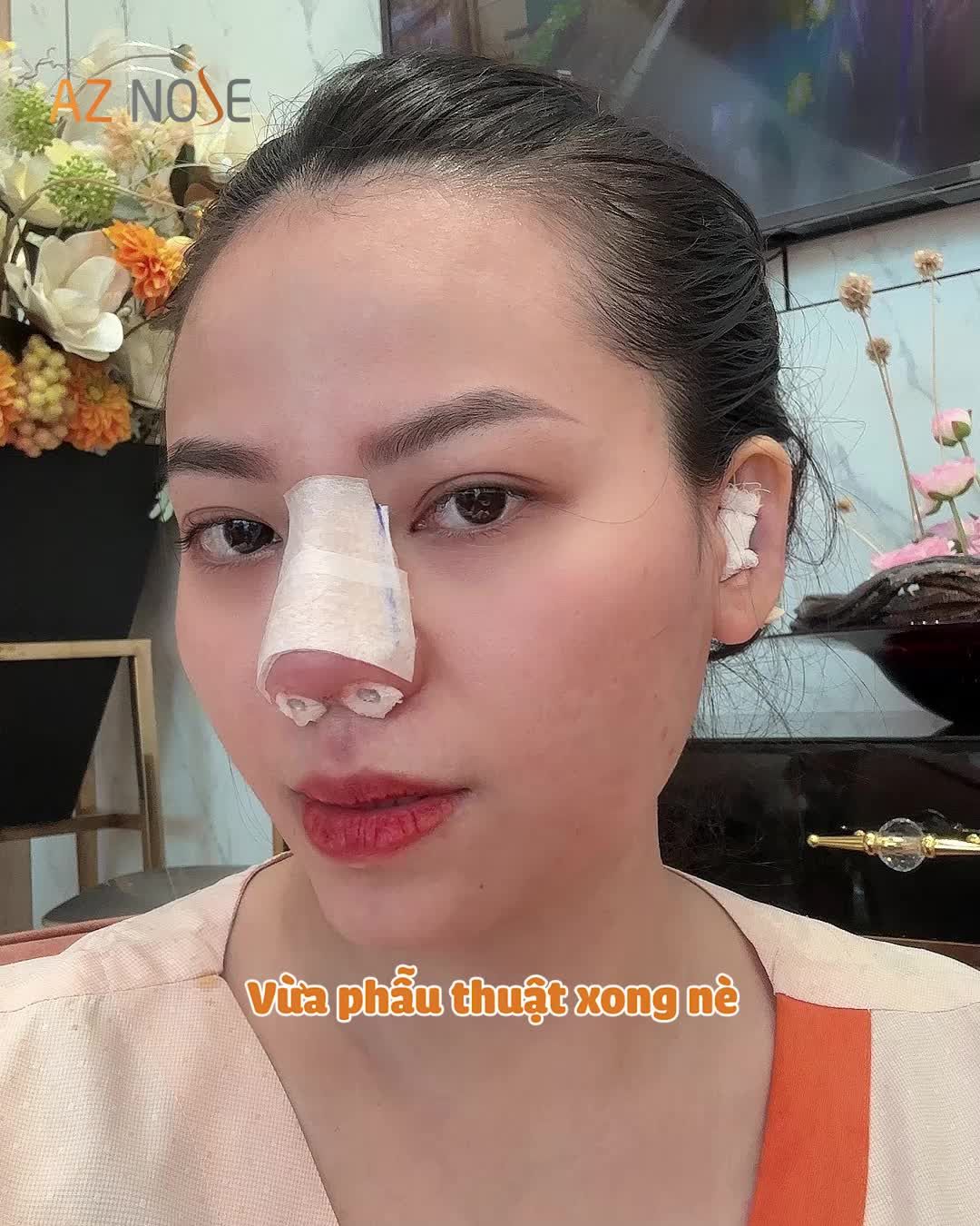 “Bye bye” chiếc mũi ng.ắn sau 2 năm nâng mũi nhân tạo