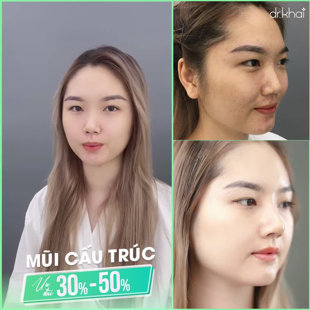 HÀNH TRÌNH CỦA KHÁCH HÀNG SAU 7 NGÀY NÂNG MŨI