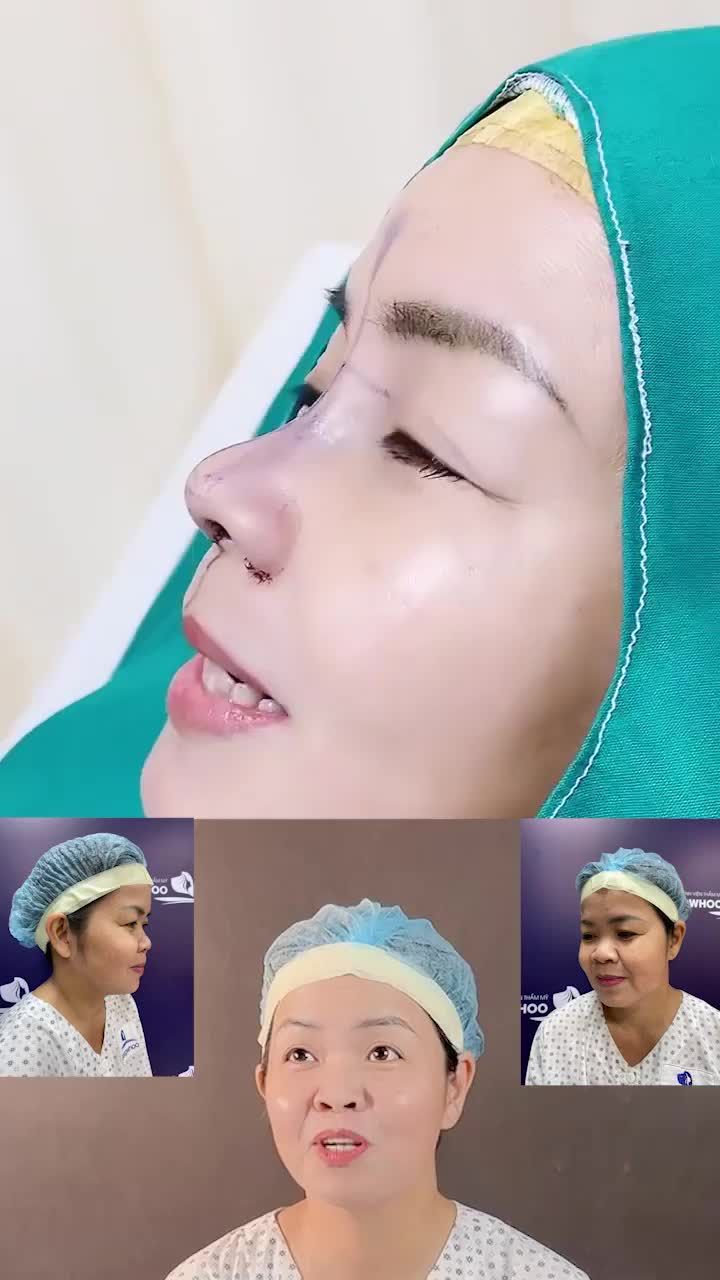VÌ SAO NÂNG MŨI CẤU TRÚC ĐƯỢC MỆNH DANH LÀ VUA CÁC PHƯƠNG PHÁP NÂNG MŨI?