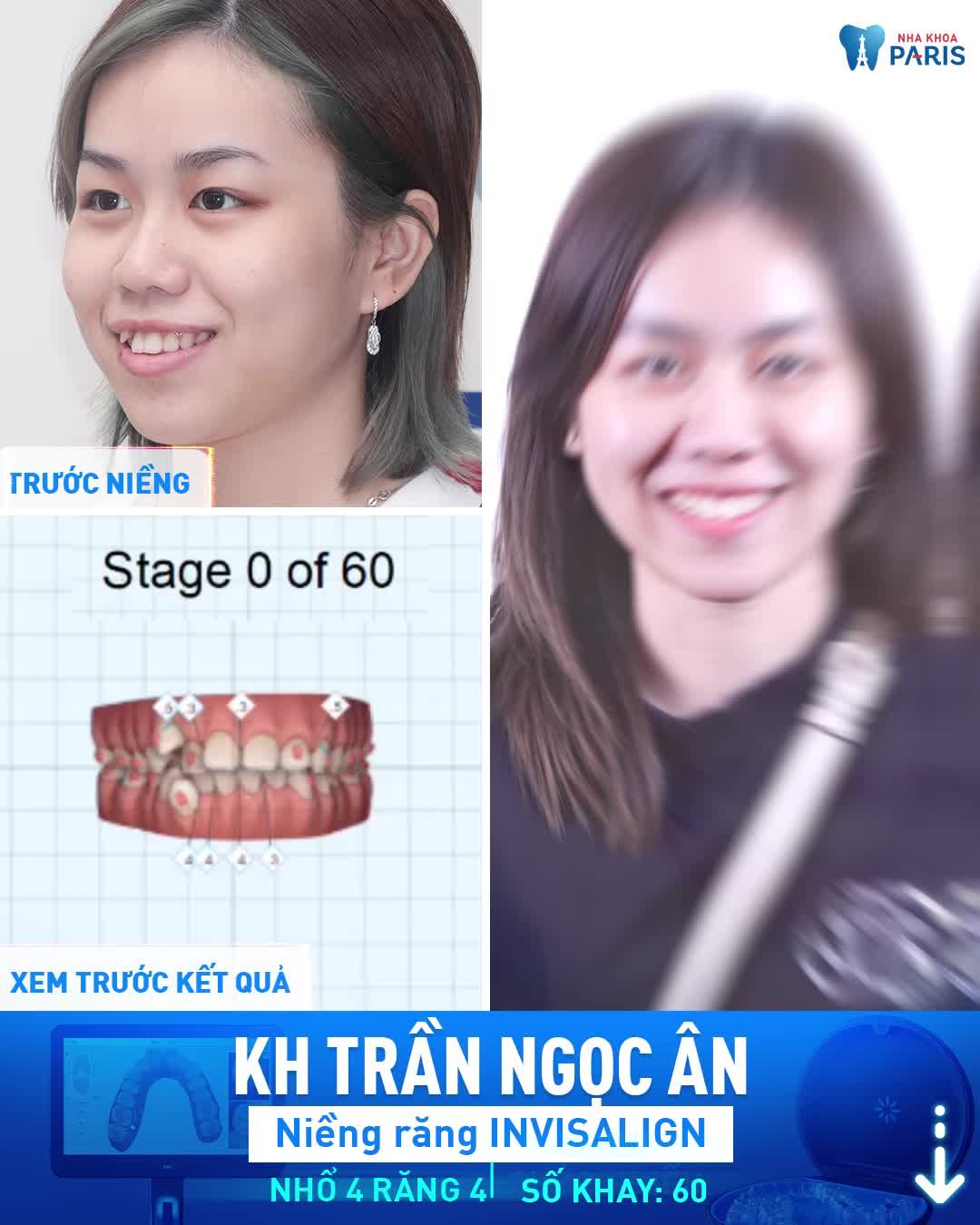 Niềng Răng “Vô Hình” Invisalign
