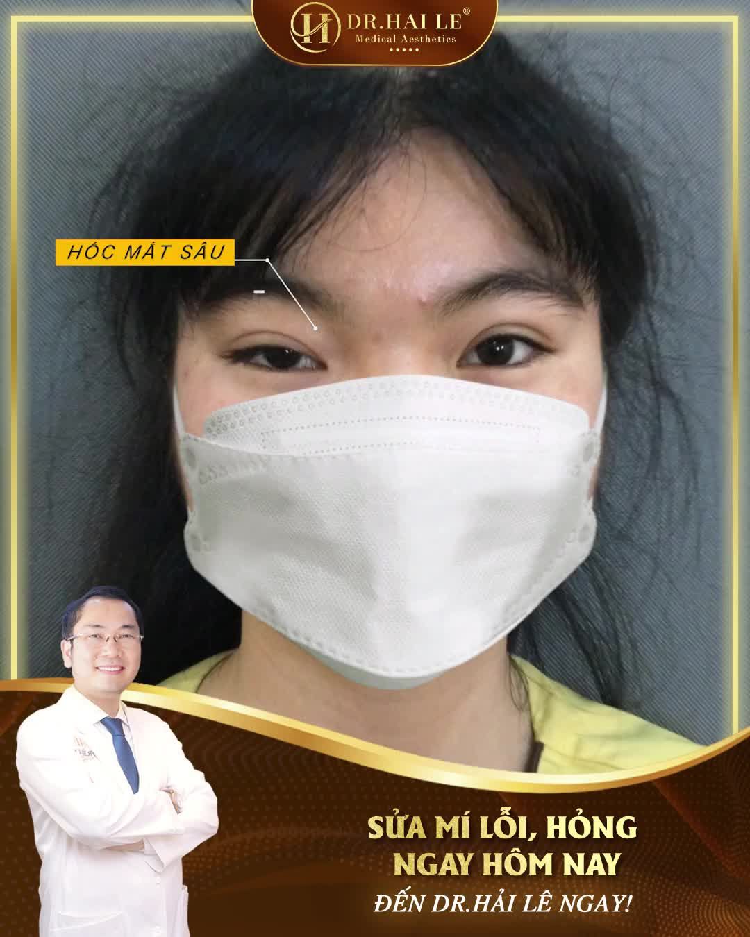 Sửa mí lỗi hỏng ngay hôm nay với Dr.Hải Lê, tại sao không?