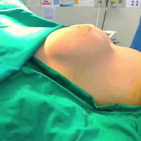 Tranh thủ khoe với chị em mình một chút kết quả sau 45 phút thực hiện nâng cấp vòng 1 cho một trong những khách hàng hôm nay của Saigon Young đây ạ.
