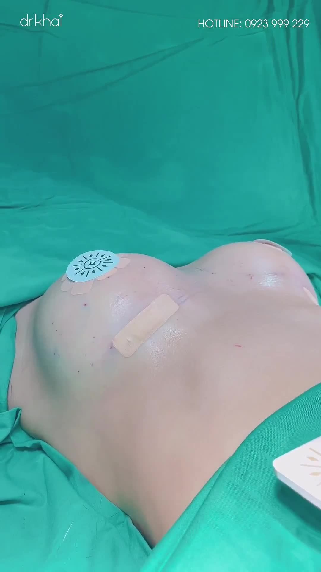 VÒNG 1 ĐẸP CHO KHÁCH HÀNG ĐÃ SINH CON