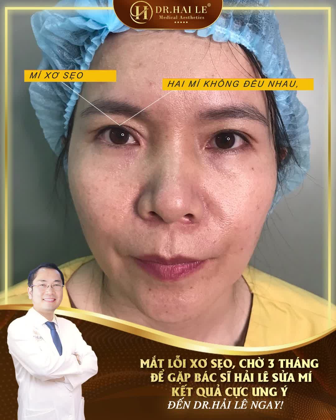 Mí xơ sẹo cứng, làm sao để khắc phục?