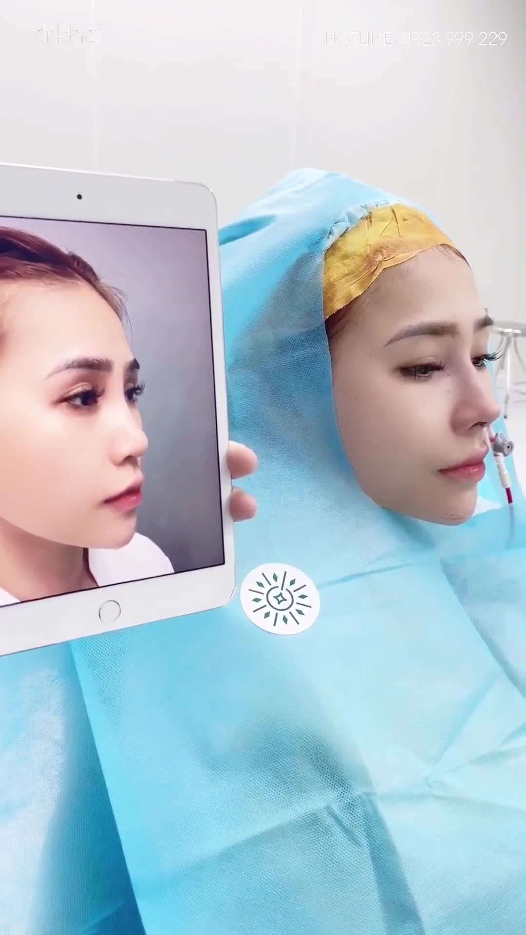 CẬP NHẬT NHANH KẾT QUẢ NÂNG MŨI CẤU TRÚC SURGIFORM CỰC ĐẸP NGAY TẠI PHÒNG PHẪU THUẬT
