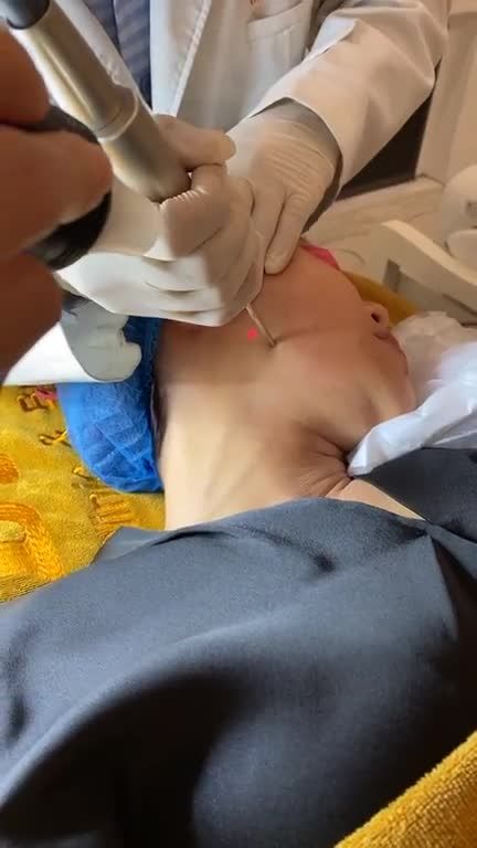 Khách hàng điều trị giãn mao mạch ở 2 bên má.