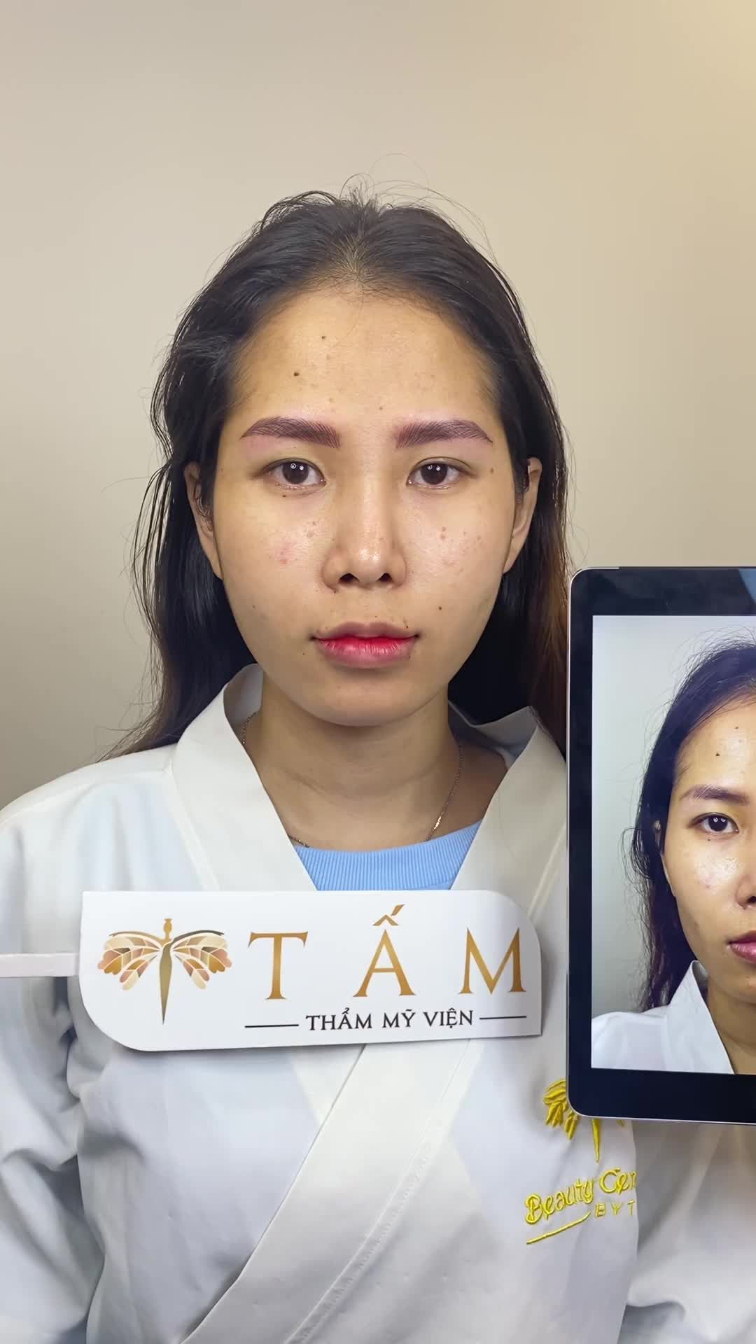 Ca cân chỉnh gương mặt combo filler 8cc tại phòng khám TMV Tấm. Mọi người cùng xem phần thái dương và má của bạn khách đã thay đổi rõ rệt trước và sau làm nhé.
