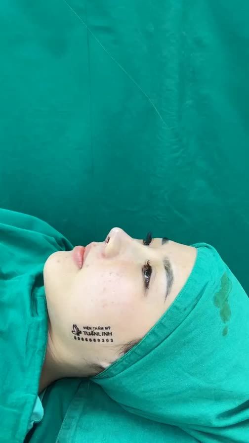 Case mũi cấu trúc surigform vừa hoàn thành