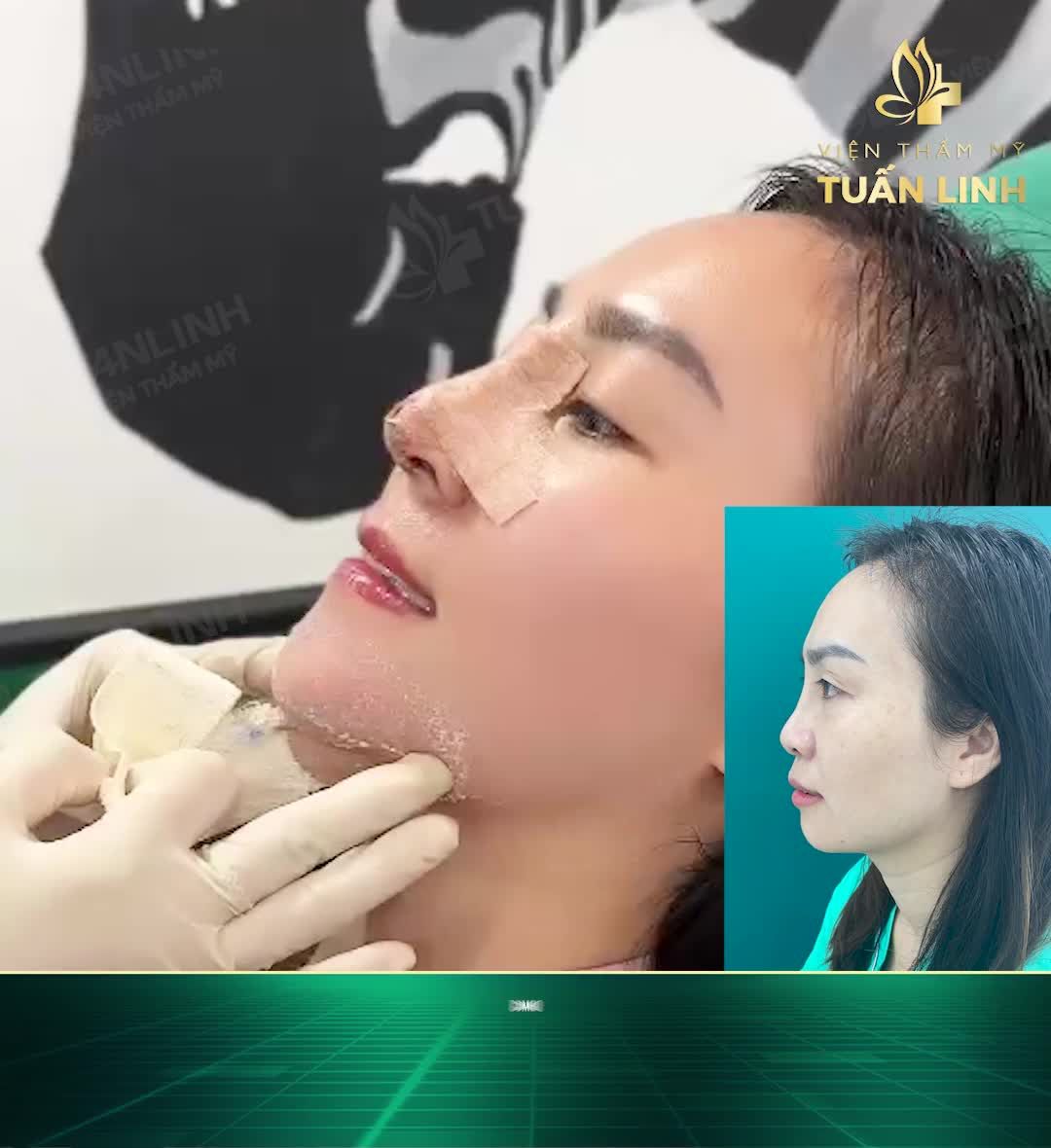 Combo Nâng mũi cấu trúc Surgiform + độn cằm Vline =Khiến ai cũng siêu lòng!!