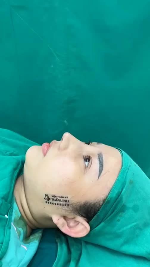 Case mũi cấu trúc surgiform vừa hoàn thành