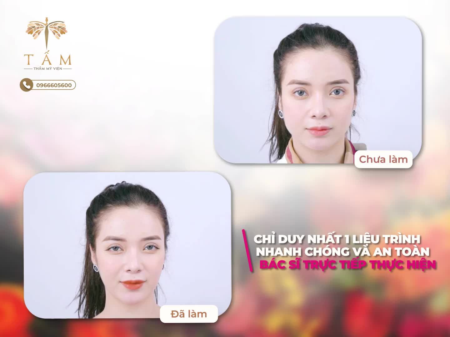 Mặt to vuông, hàm bạnh, nhiều cơ mỡ tích tụ, da chảy xệ ở vùng hàm...không còn là nỗi lo với phương pháp VLINE PERFECT thon gọn hàm tại Tấm
