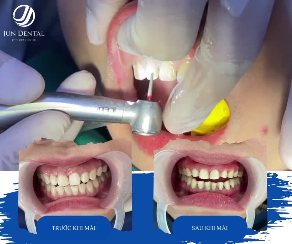 TRỒNG RĂNG IMPLANT – LỰA CHỌN SỐ 1 KHI BỊ MẤT RĂNG