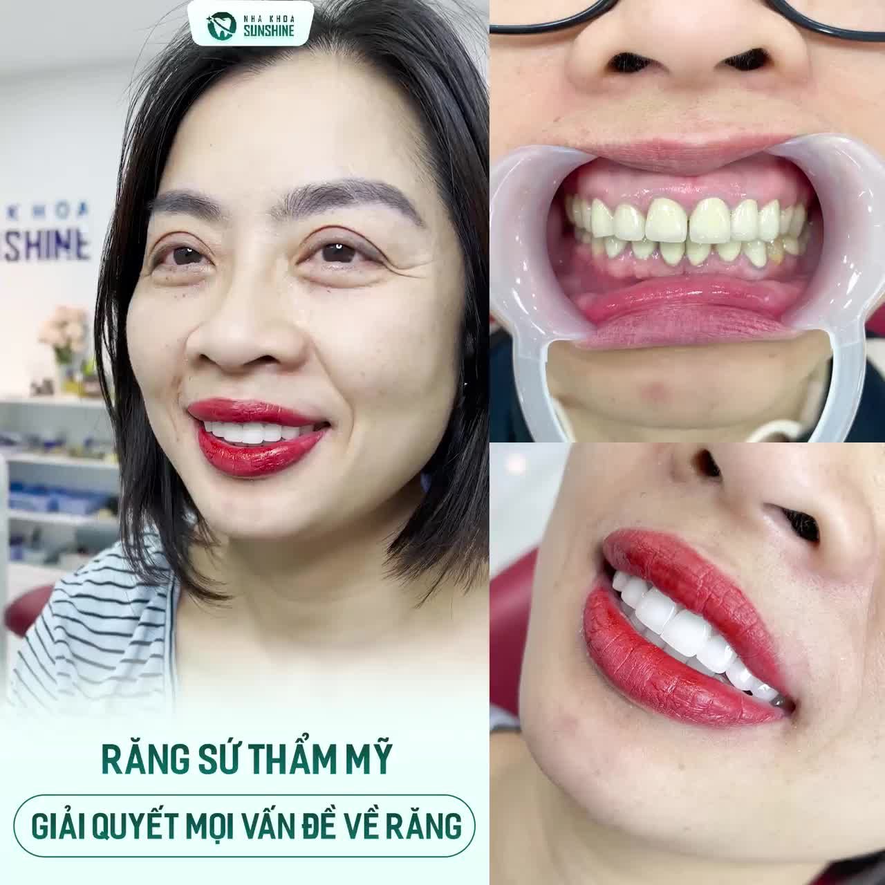 THẨM MỸ RĂNG SỨ TẠI SUNSHINE - GIẢI QUYẾT MỌI VẤN ĐỀ VỀ RĂNG