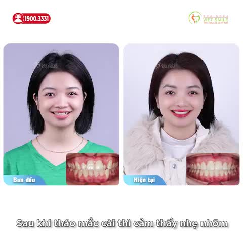 ĐÓN NỤ CƯỜI MỚI SAU THÁO NIỀNG RĂNG KHẤP KHỂNH