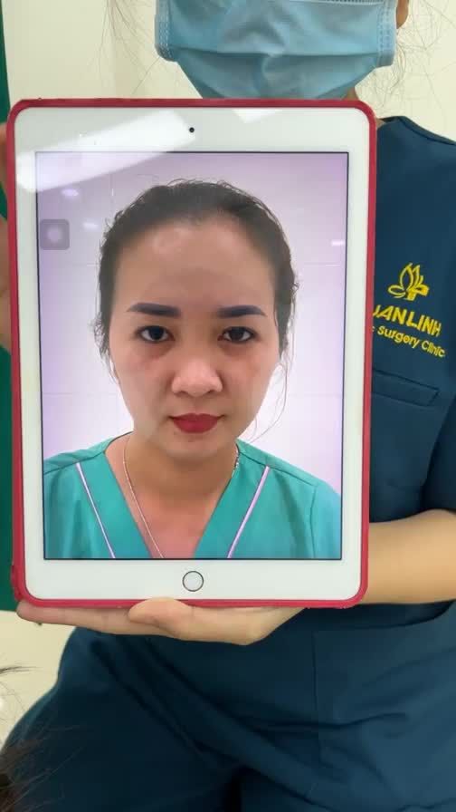 Case độn cằm cho khách hàng đã nâng mũi tại viện