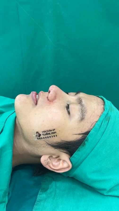 Combo nâng mũi độn cằm cho khách hàng từ Mỹ