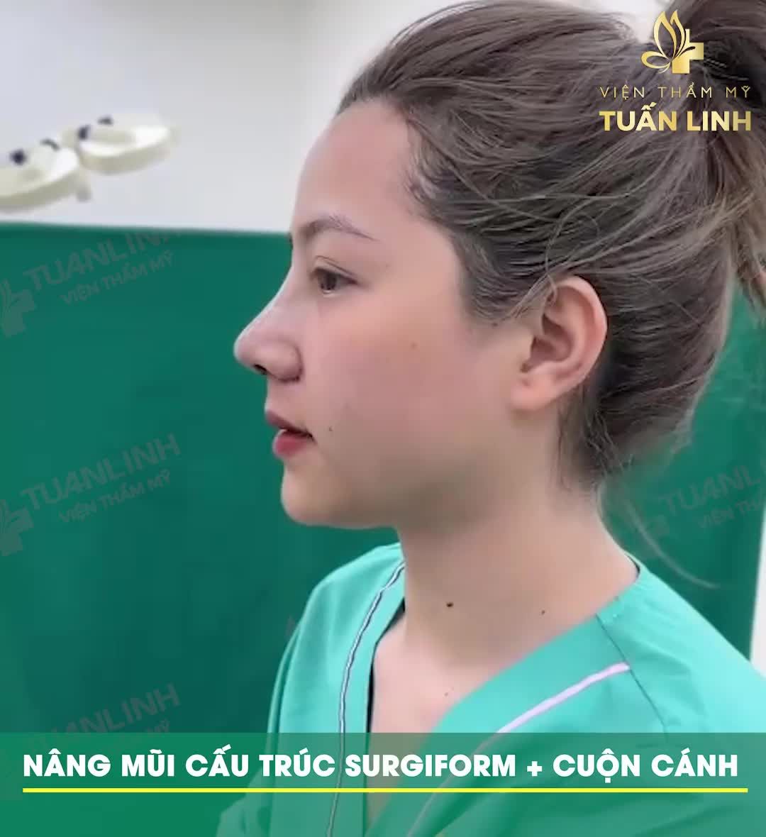 '' Phẫu thuật xong, vừa nhìn thấy dáng mũi là mình đã cực kỳ hài lòng với dáng mũi này rồi..'' - Chia sẻ của khách hàng ngay sau 90 phút phẫu thuật.