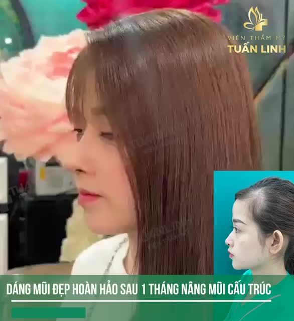 Nâng mũi sau 1 tháng sẽ như thế nào???XEM NGAY CLIP bên dưới nha!