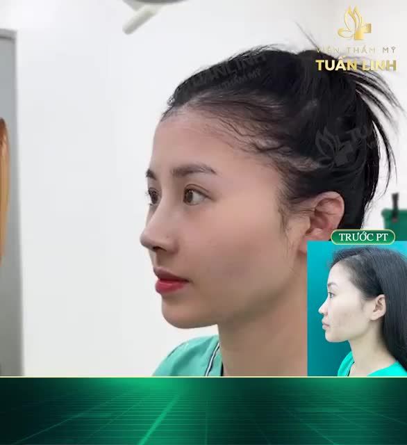 NÂNG MŨI CẤU TRÚC SURGIFORM - SỰ LỰA CHỌN HOÀN HẢO ĐỂ CÓ DÁNG MŨI BỀN ĐẸP.